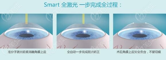 佛山全激光近视眼手术多少钱