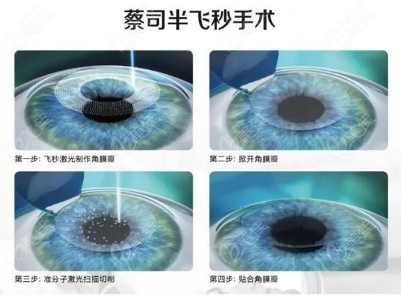 佛山半飞秒激光近视手术价格