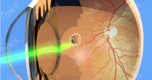 视网膜激光手术
