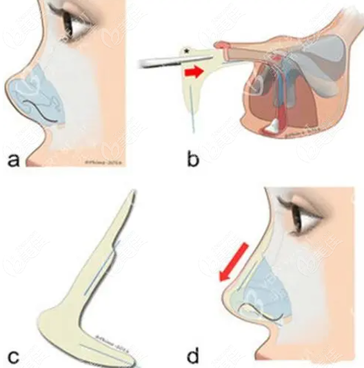隆鼻手术图示