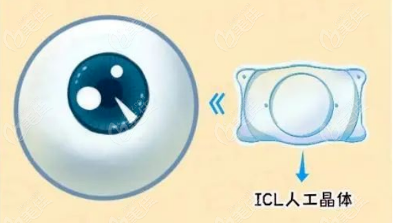icl晶体植入带散光晶体定制过程及步骤