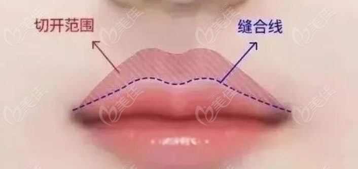 上唇切开式缩短人中