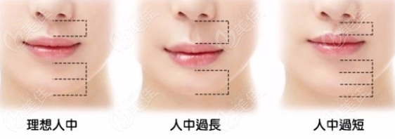 人中缩短手术可以改善过长的人中