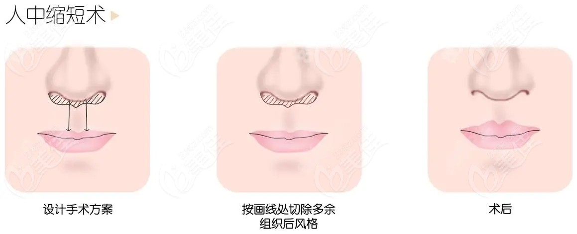 中缩短术前后对比图