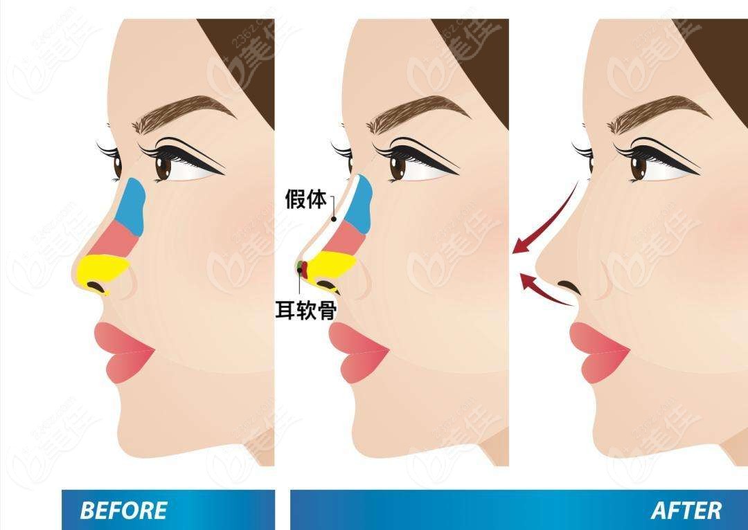 呼和浩特华美整形做隆鼻手术的技术优势www.236z.com