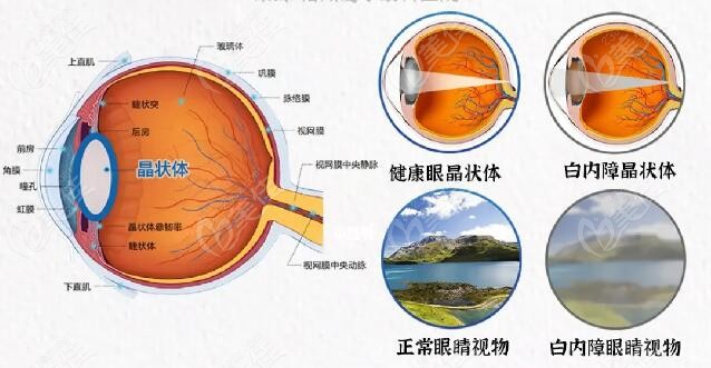 杭州愛爾眼科白內(nèi)障多少錢