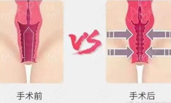 北京嘉禾医疗美容侯智慧做3D生物束带缩阴术怎么样