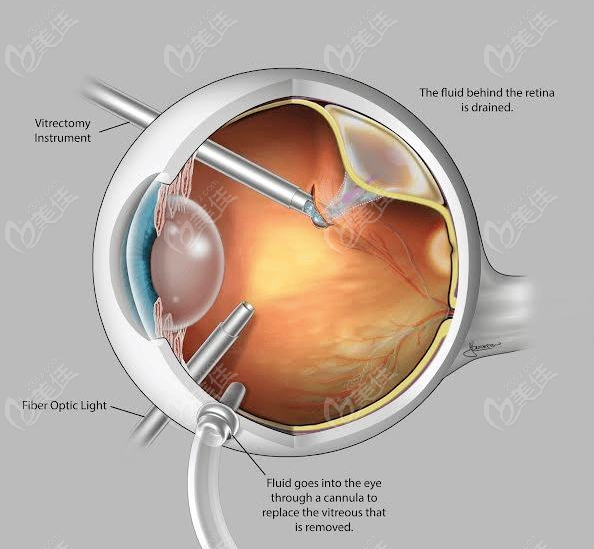 视网膜脱落手术后多久可以出院