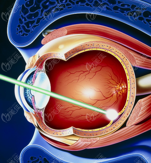 网膜脱落手术后多久可以恢复正常视力
