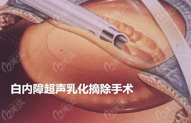 超聲乳化白內(nèi)障手術的并發(fā)癥概率