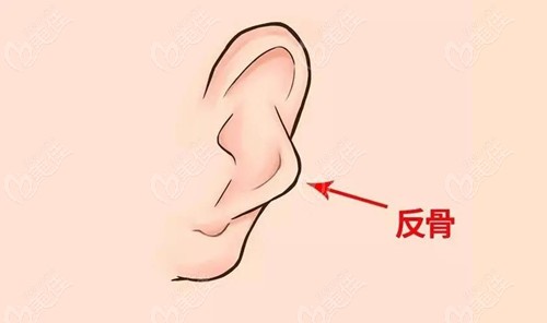 反骨耳矫正手术事例