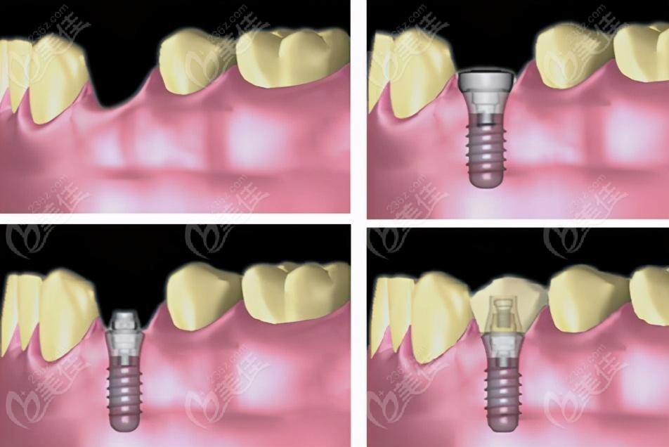 合肥贝洁口腔种植牙做种植牙过程