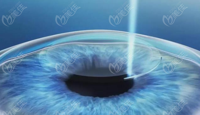 激光类近视手术需要角膜厚度在470μm以上
