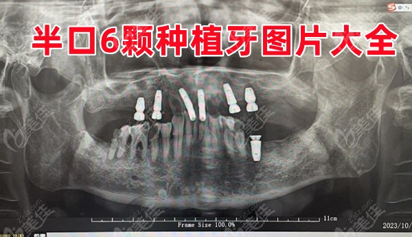 半口6顆種植牙圖片大全