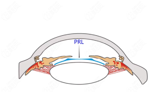 PRL晶体植入手术