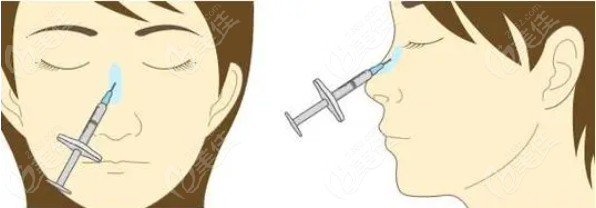 注射少女針隆鼻術(shù)后鼻型好看