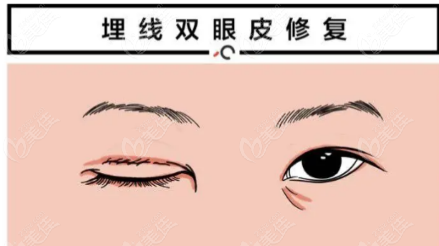 郑州东方贺洁医生做双眼皮手术