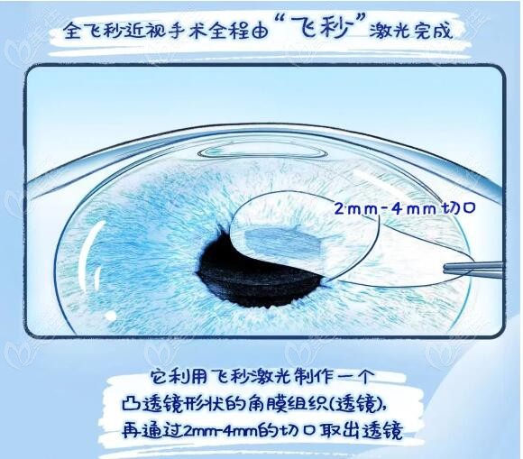 刘苏冰全飞秒近视手术技术好水平高www.236z.com
