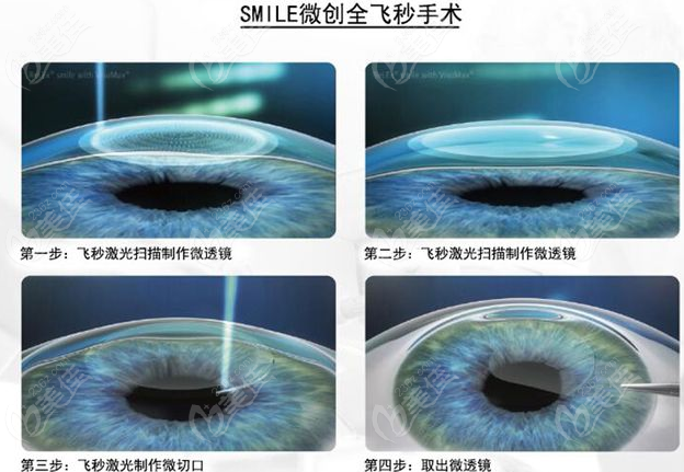 飛秒手術優勢 236z.com