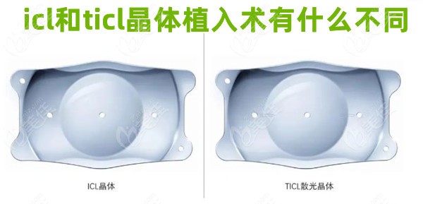 icl和ticl晶体植入术有什么不同