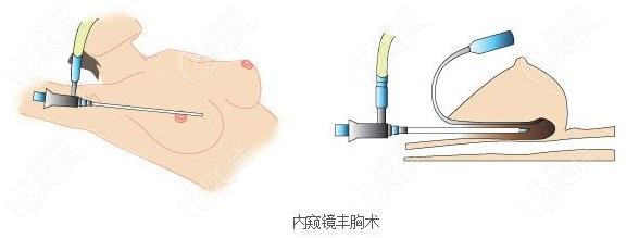 吳氏嘉美隆胸好的醫生
