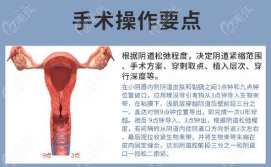 3d生物束带紧缩术是怎么做的m.236z.com