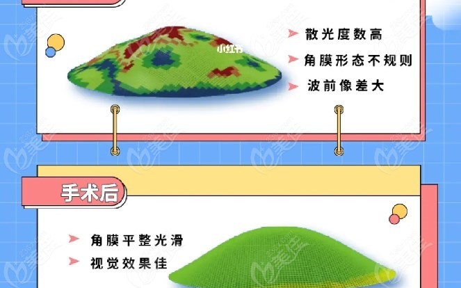 个性化半飞秒手术