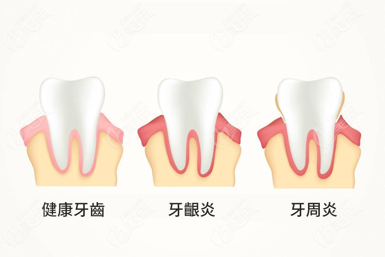 牙周炎的不同程度图www.236z.com