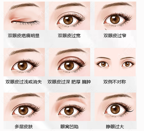 孙军双眼皮修复技术好236z.com