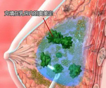 清奧手術(shù)對(duì)醫(yī)院的要求