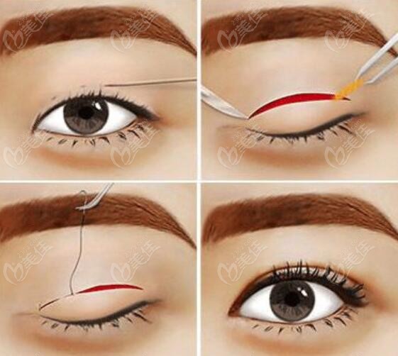 沈陽北方整形醫(yī)院李妍醫(yī)生做雙眼皮好m.236z.com 沈陽北方整形醫(yī)院李妍醫(yī)生做雙眼皮好m.236z.com