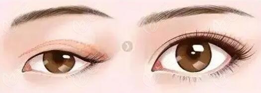 沈陽北方整形醫(yī)院王占福醫(yī)生眼綜合做的好 沈陽北方整形醫(yī)院王占福醫(yī)生眼綜合做的好