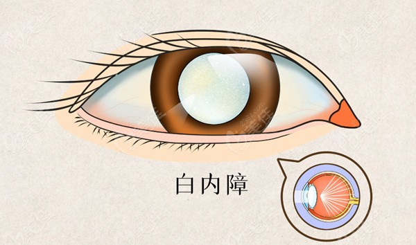 人工晶體懸吊術優勢及適用人群