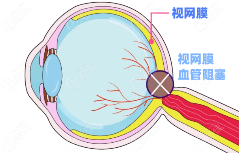 视网膜中央动脉阻塞的治疗方法