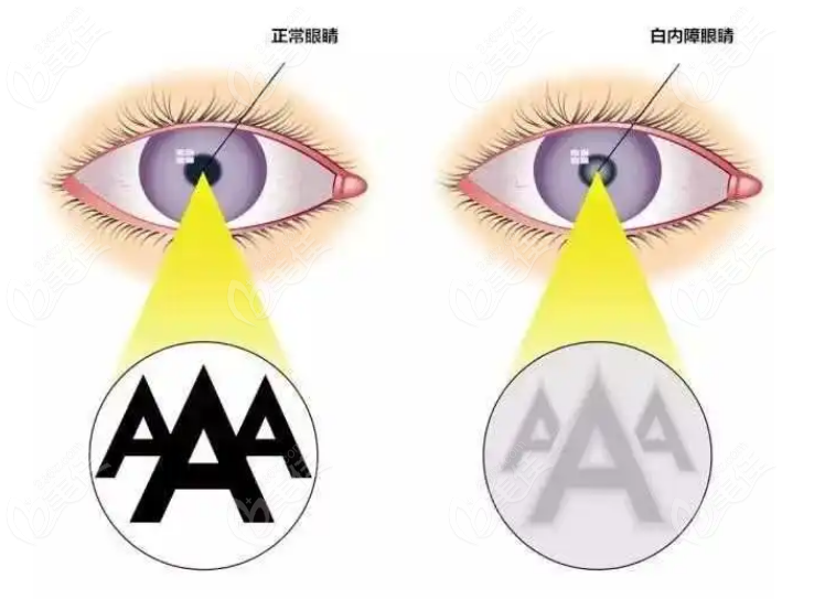 患有白內(nèi)障和高血壓做白內(nèi)障手術有風險