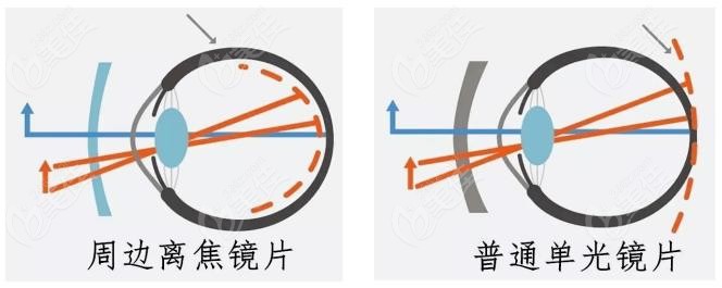 梦戴维rgp离焦软镜和普通镜片区别