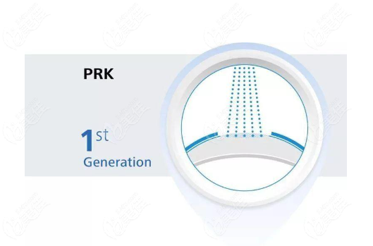 PRK准分子激光角膜切削术