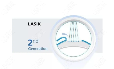  LASIK准分子激光角膜磨镶术