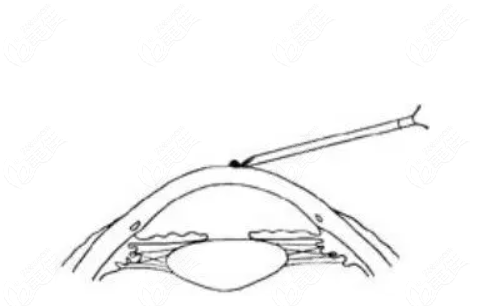 LASIK+ICRS合并角膜环状切割术