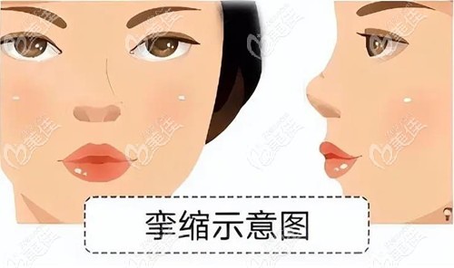 李信鋒高難度鼻攣縮修復手術做的好