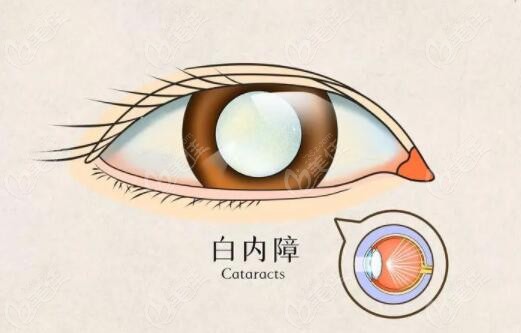 黑龙江长庚眼耳鼻喉医院做白内障手术怎么样