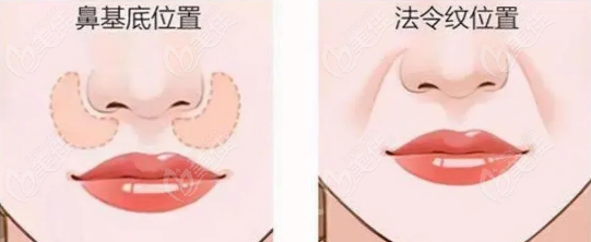 鼻基底填充用什么牌子玻尿酸比较好用www.236z.com