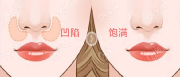玻尿酸填充鼻基底多少钱