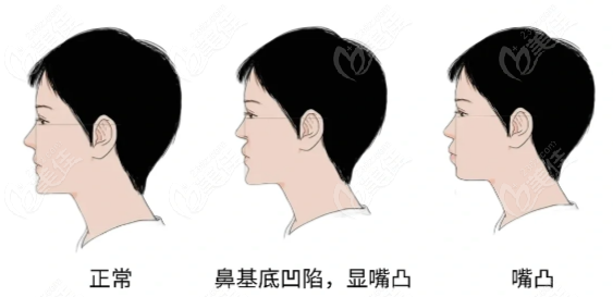玻尿酸填充鼻基底凹陷