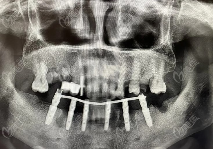 苏州华尔康口腔半口即刻负重种植牙