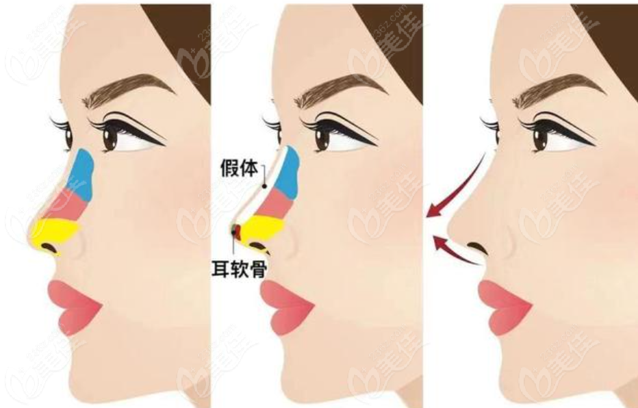 杭州谭晓燕医生做的肋骨鼻综合图片m.236z.com