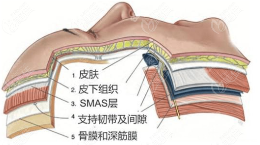 拉皮手術(shù)圖示