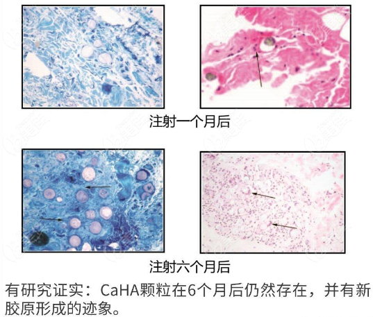 菲利普利果凍針填充療效自然