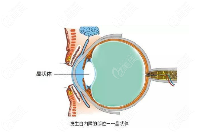 白内障的眼睛