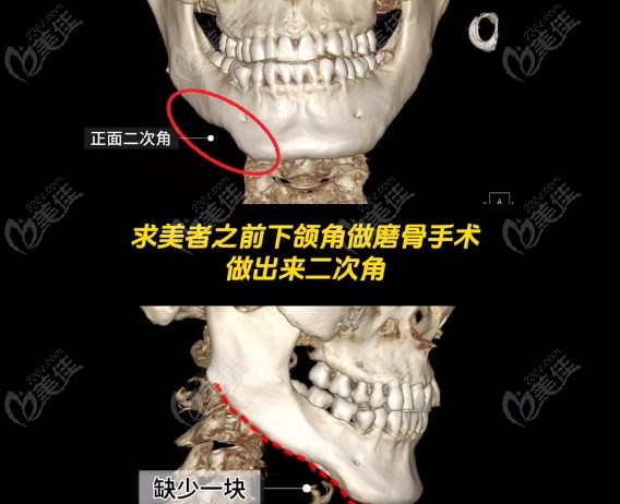3d打印人工骨修复下颌角手术m.236z.com